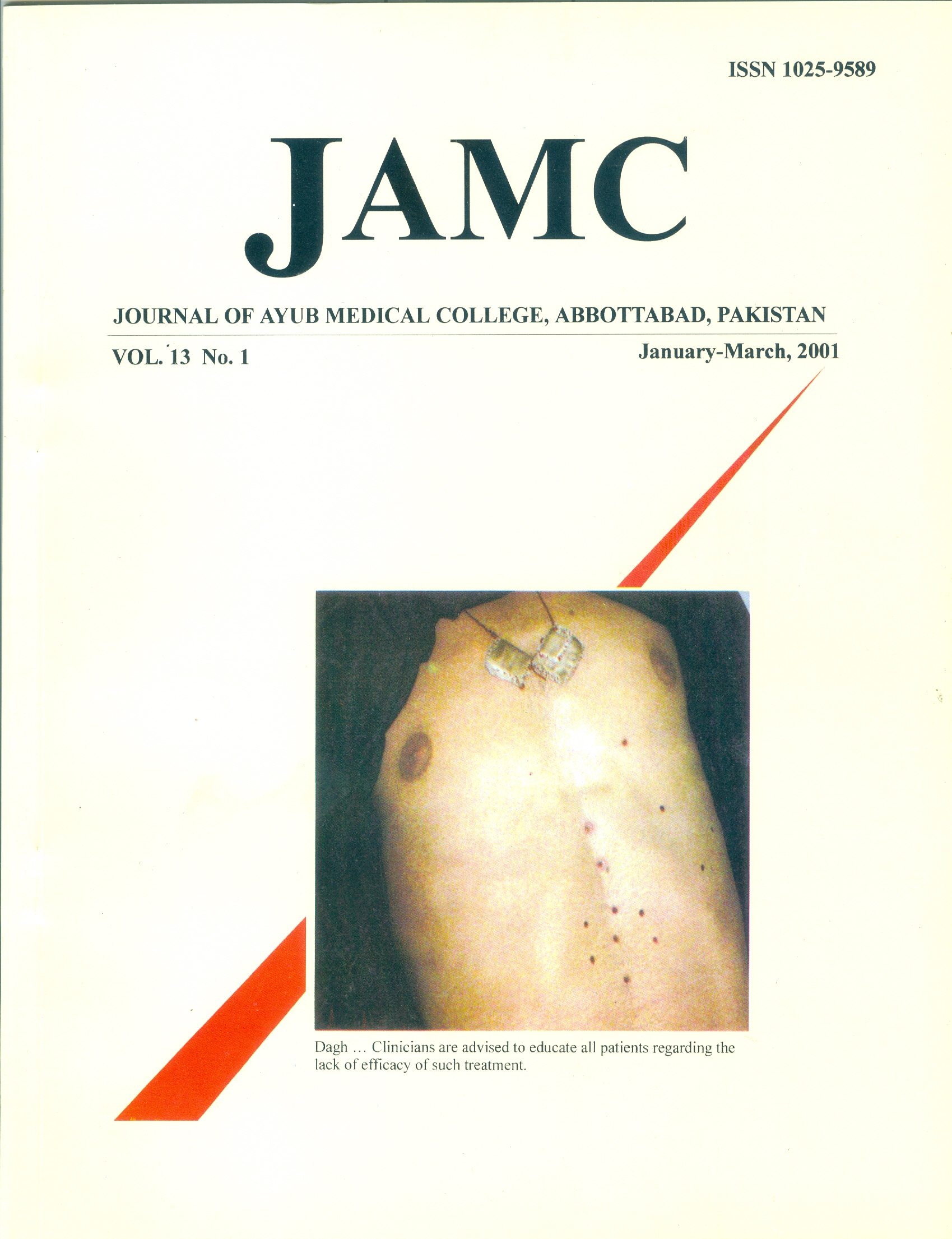 					View Vol. 13 No. 1 (2001): JOURNAL OF AYUB MEDICAL COLLEGE, ABBOTTABAD
				